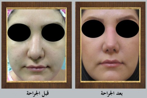 عملية تجميل الأنف