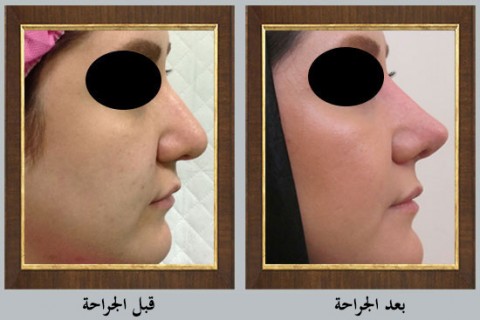 عملية تجميل الأنف