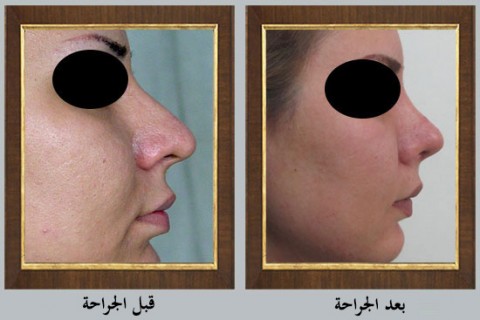 عملية تجميل الأنف