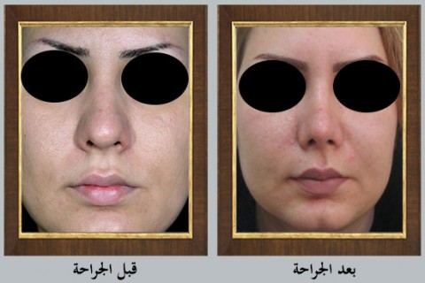 عملية تجميل الأنف