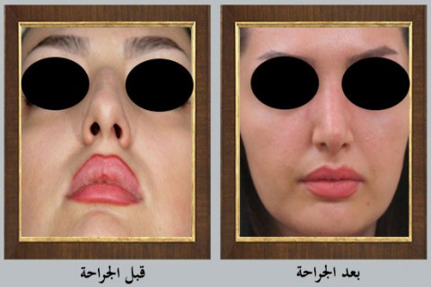 عملية تجميل الأنف