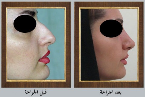 عملية تجميل الأنف